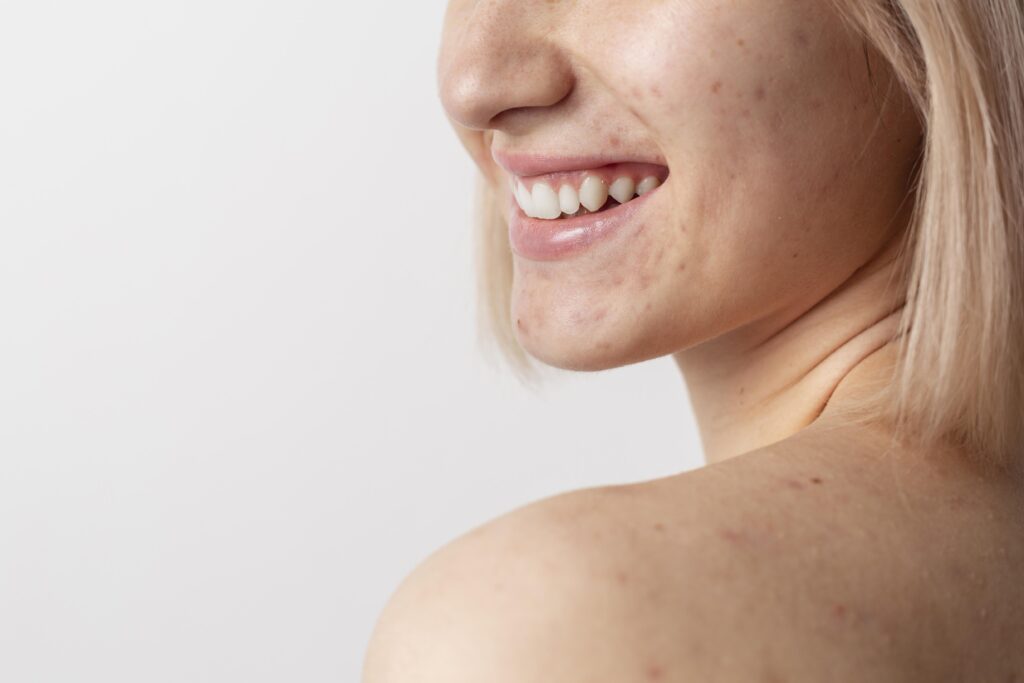 Soin naturel pour l’acné, femme avec des boutons - NYM Cosmétiques