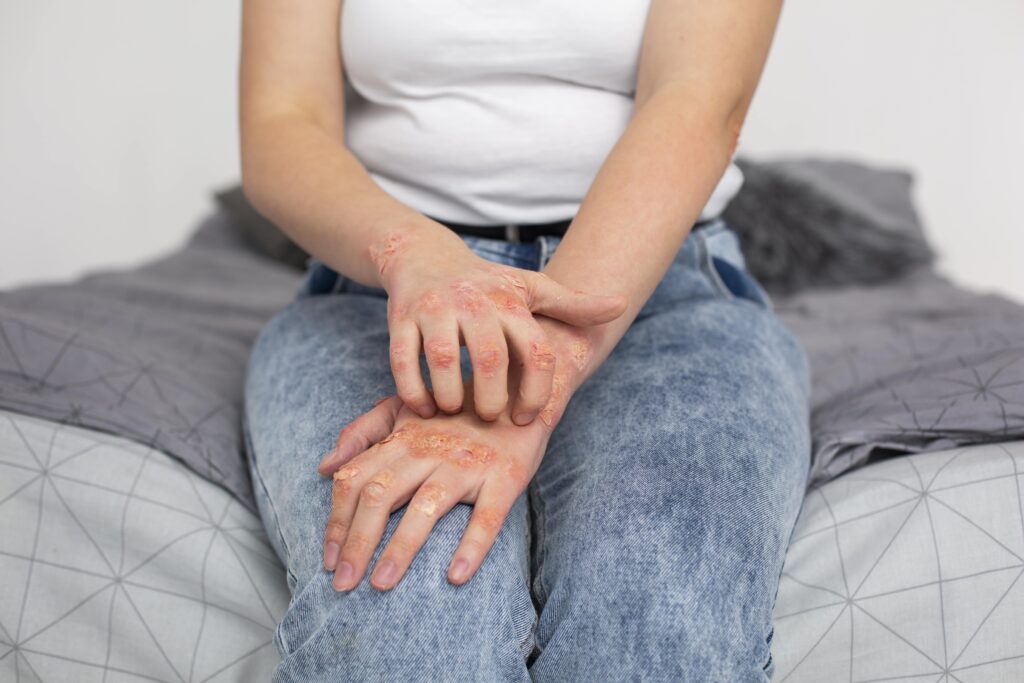Eczéma - Psoriasis : Apaiser naturellement les peaux sensibles 