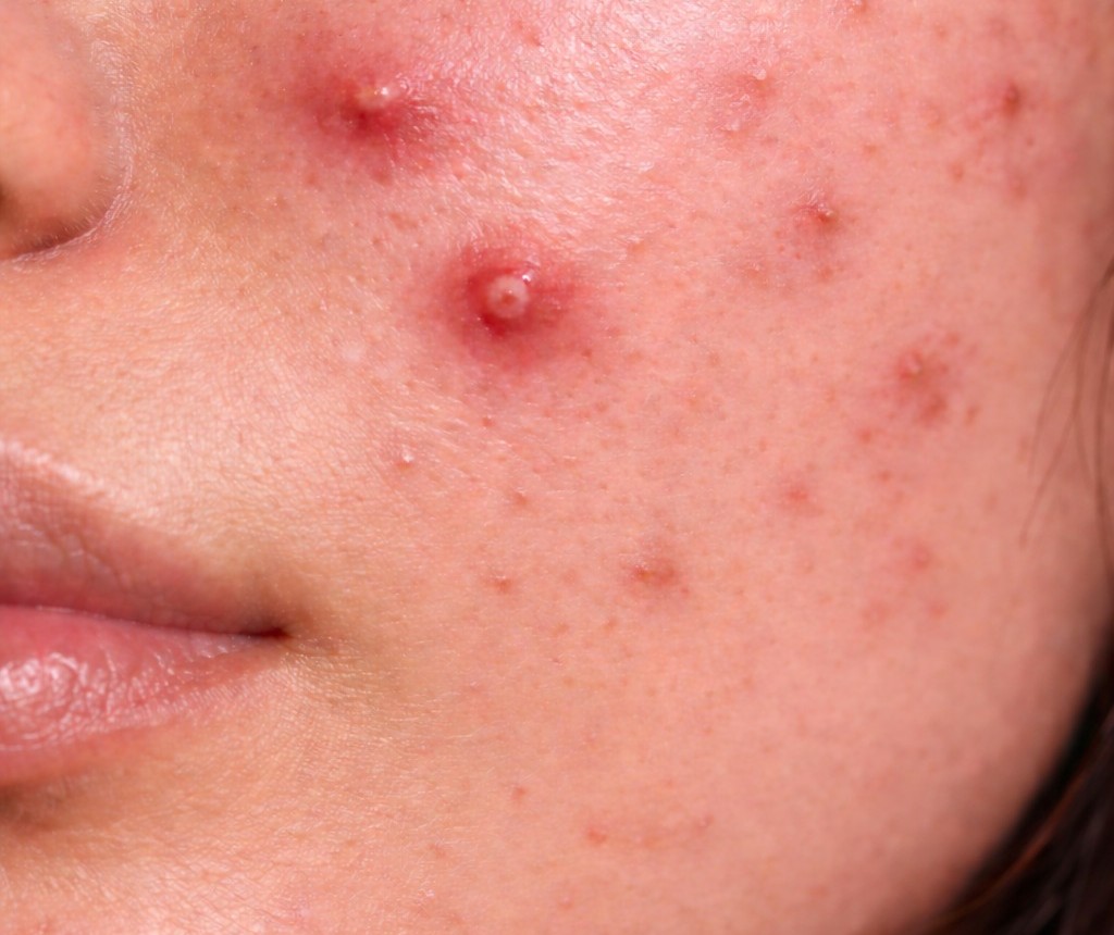 Pack anti-imperfections