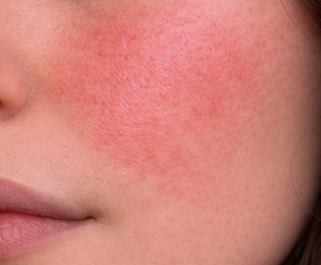 Peau sensible